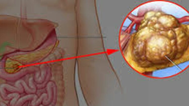 Pancreatic Cancer Breakthrough Gives New Hope: Patients, Treatment, Survival and New Drug Advances Could Change the Future