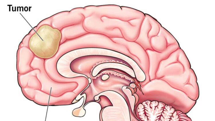Personalized Glioblastoma Vaccine Shows Hope Against Deadly Brain Cancer as New Glioblastoma Treatment Extends Survival in Clinical Trial